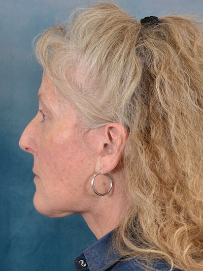 Brow Lift Before & After Gallery - Patient 256405 - Image 6