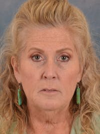 Brow Lift Before & After Gallery - Patient 256405 - Image 1