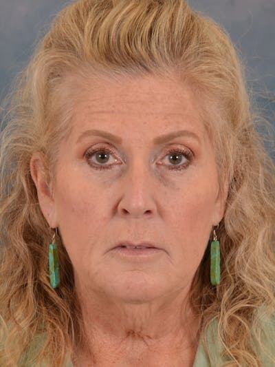 Brow Lift Before & After Gallery - Patient 256405 - Image 1