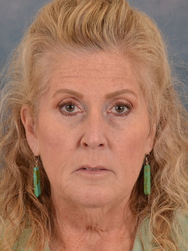 Brow Lift Before & After Gallery - Patient 256405 - Image 1