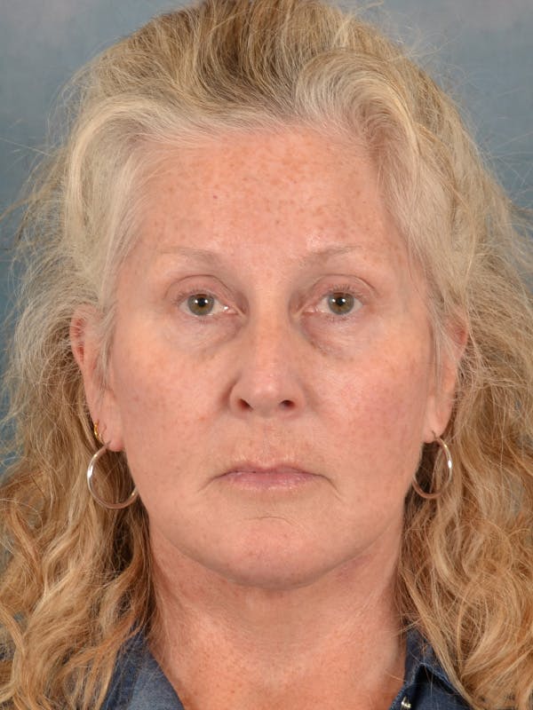 Brow Lift Before & After Gallery - Patient 256405 - Image 2