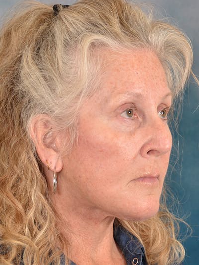 Brow Lift Before & After Gallery - Patient 256405 - Image 8