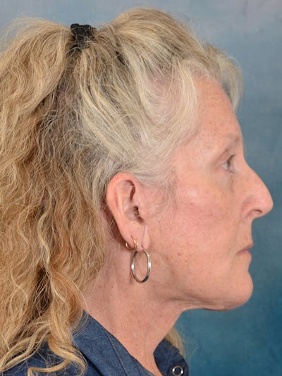 Brow Lift Before & After Gallery - Patient 256405 - Image 10