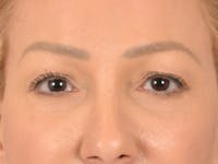 Eyelid Lift Before & After Gallery - Patient 239635 - Image 1