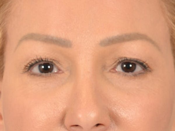 Eyelid Lift Before & After Gallery - Patient 239635 - Image 1