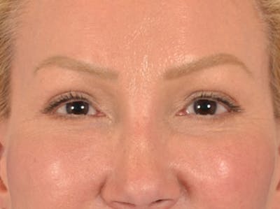 Eyelid Lift Before & After Gallery - Patient 239635 - Image 2