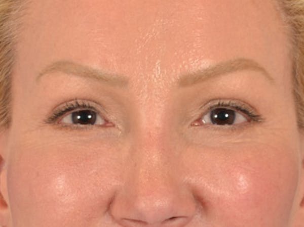 Eyelid Lift Before & After Gallery - Patient 239635 - Image 2