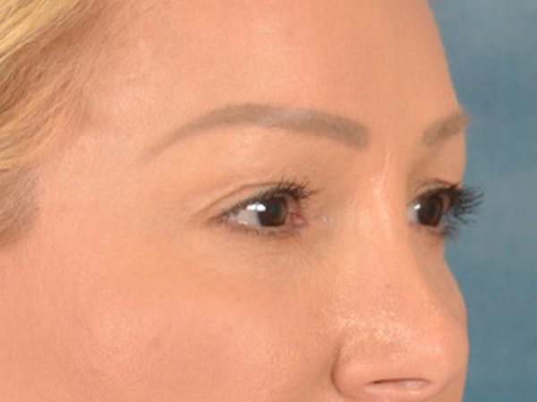 Eyelid Lift Before & After Gallery - Patient 239635 - Image 3