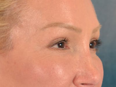 Eyelid Lift Before & After Gallery - Patient 239635 - Image 4