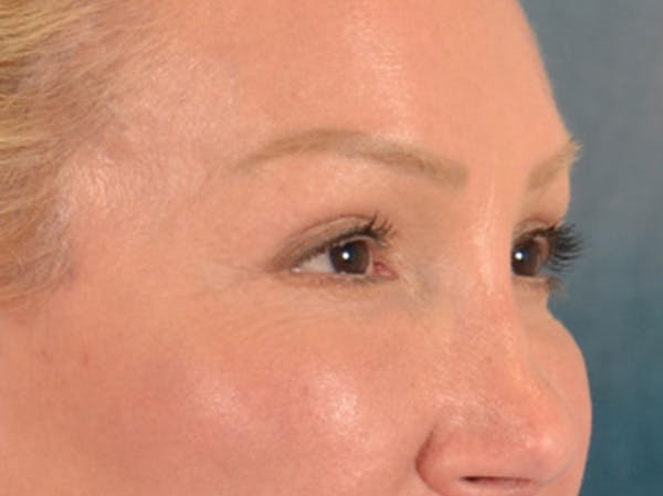 Eyelid Lift Before & After Gallery - Patient 239635 - Image 4