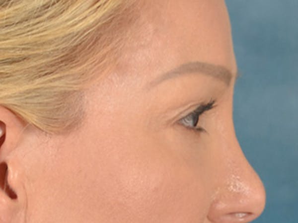 Eyelid Lift Before & After Gallery - Patient 239635 - Image 5