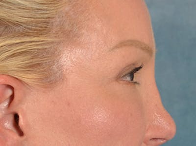 Eyelid Lift Before & After Gallery - Patient 239635 - Image 6