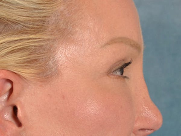 Eyelid Lift Before & After Gallery - Patient 239635 - Image 6