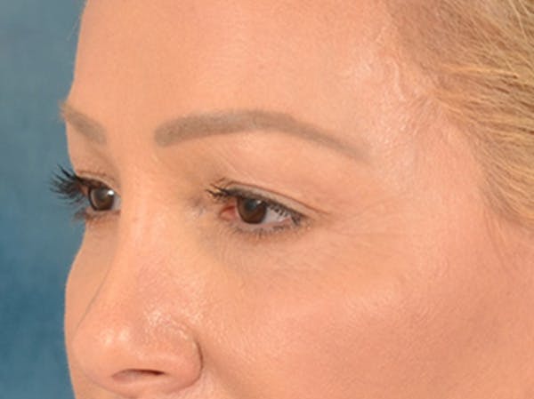 Eyelid Lift Before & After Gallery - Patient 239635 - Image 7