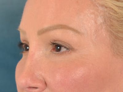 Eyelid Lift Before & After Gallery - Patient 239635 - Image 8