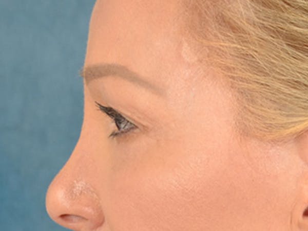 Eyelid Lift Before & After Gallery - Patient 239635 - Image 9