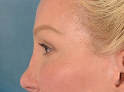 Eyelid Lift Before & After Gallery - Patient 239635 - Image 10
