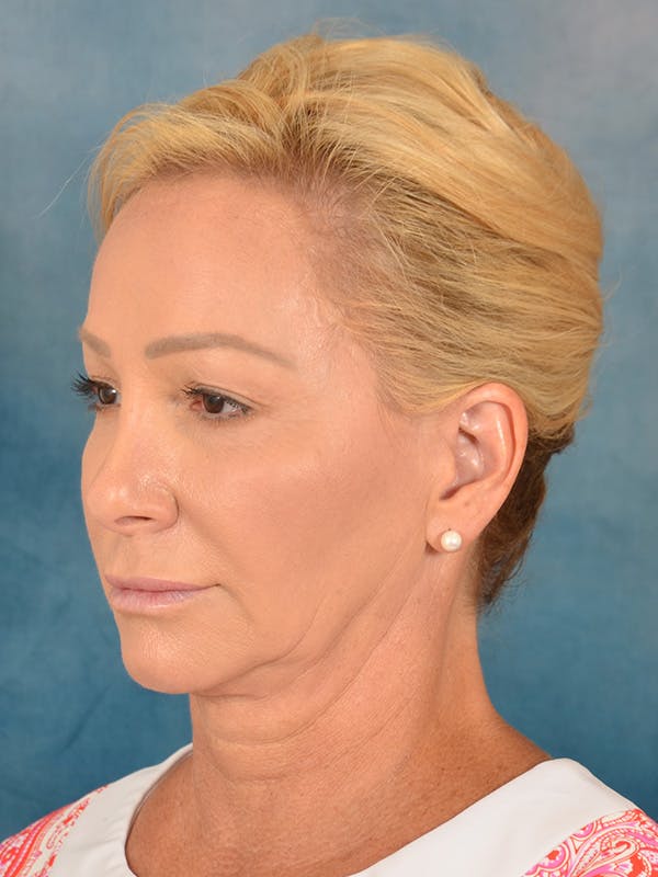 Laser Skin Resurfacing Before & After Gallery - Patient 209353 - Image 3