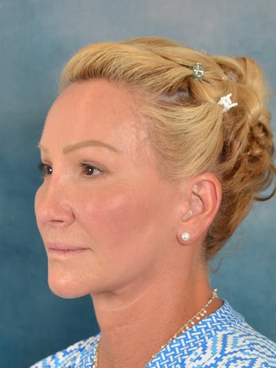 Laser Skin Resurfacing Before & After Gallery - Patient 209353 - Image 4