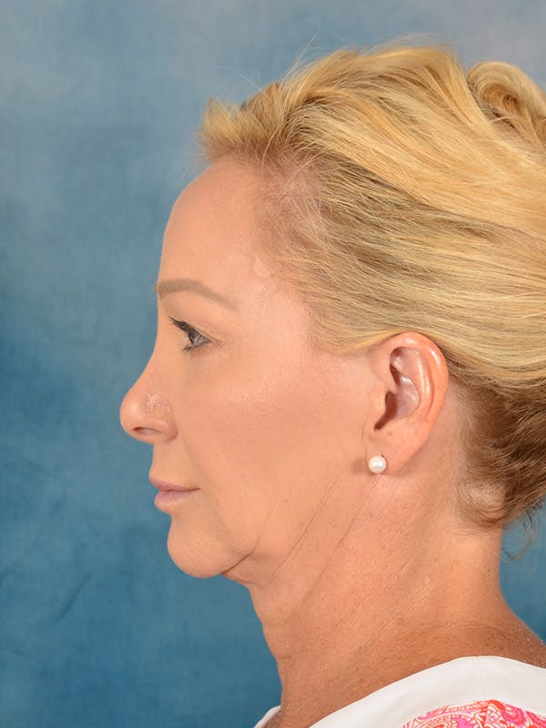 Laser Skin Resurfacing Before & After Gallery - Patient 209353 - Image 5