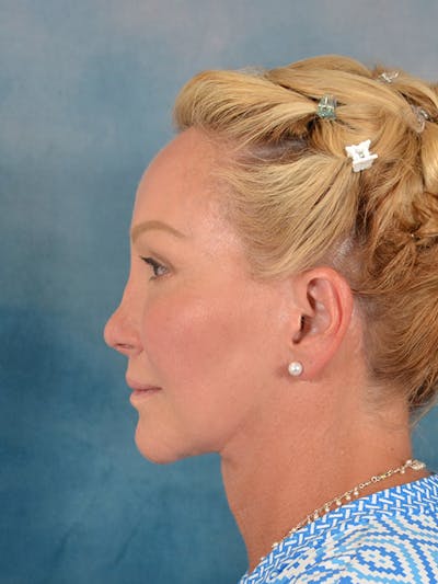 Laser Skin Resurfacing Before & After Gallery - Patient 209353 - Image 6
