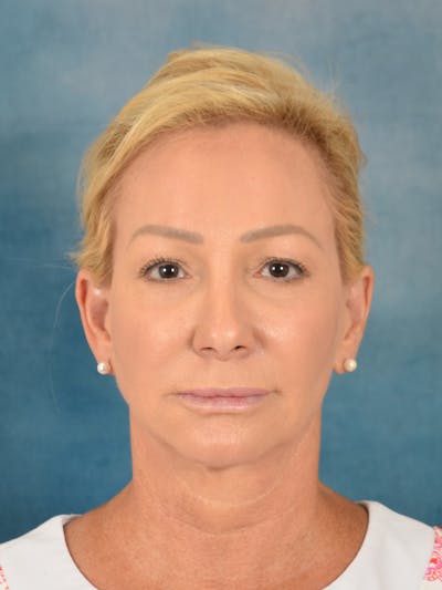 Laser Skin Resurfacing Before & After Gallery - Patient 209353 - Image 1
