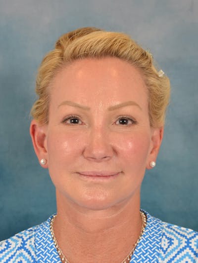 Laser Skin Resurfacing Before & After Gallery - Patient 209353 - Image 2
