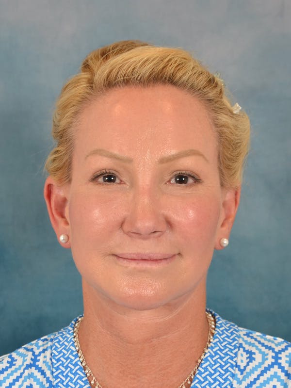 Laser Skin Resurfacing Before & After Gallery - Patient 209353 - Image 2