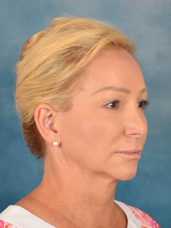 Laser Skin Resurfacing Before & After Gallery - Patient 209353 - Image 7