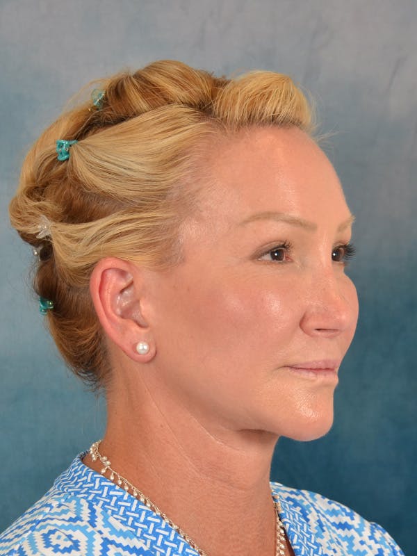 Laser Skin Resurfacing Before & After Gallery - Patient 209353 - Image 8