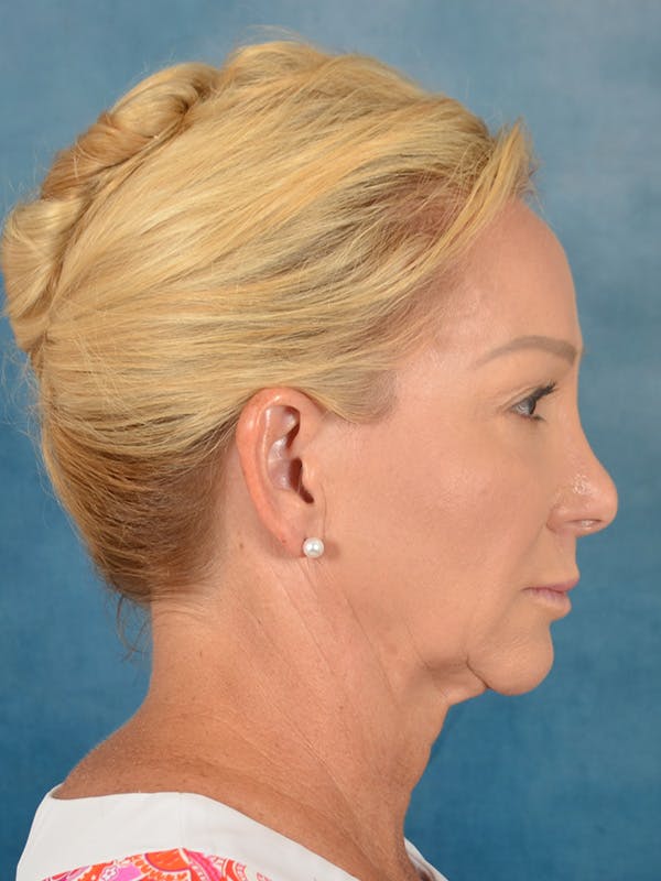 Laser Skin Resurfacing Before & After Gallery - Patient 209353 - Image 9