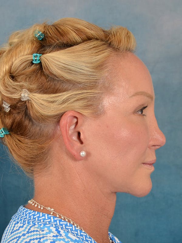 Laser Skin Resurfacing Before & After Gallery - Patient 209353 - Image 10