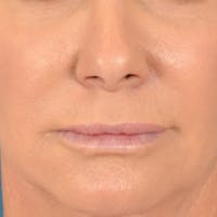 Lip Lift Before & After Gallery - Patient 311222 - Image 1