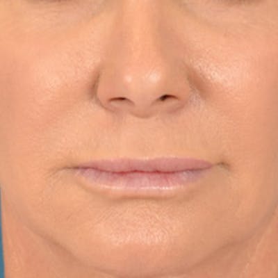 Lip Lift Before & After Gallery - Patient 311222 - Image 1