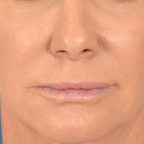 Lip Lift Before & After Gallery - Patient 311222 - Image 1