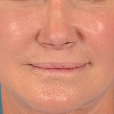 Lip Lift Before & After Gallery - Patient 311222 - Image 2