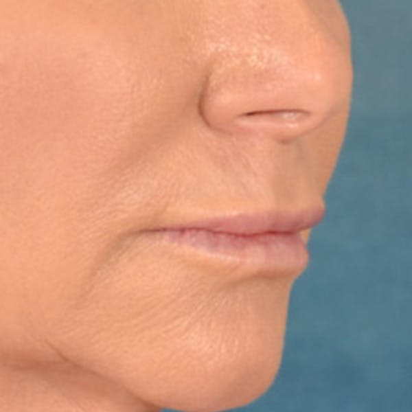 Lip Lift Before & After Gallery - Patient 311222 - Image 3