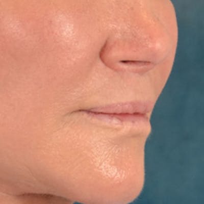 Lip Lift Before & After Gallery - Patient 311222 - Image 4