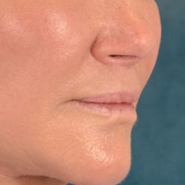 Lip Lift Before & After Gallery - Patient 311222 - Image 4