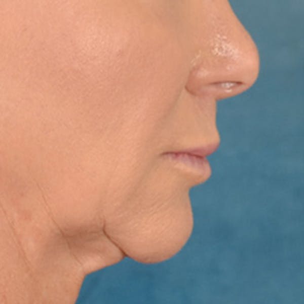 Lip Lift Before & After Gallery - Patient 311222 - Image 5
