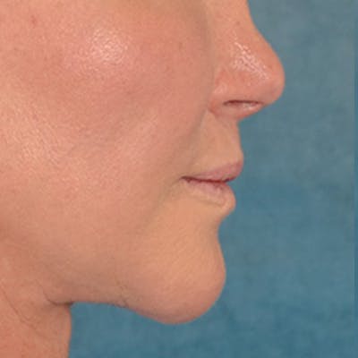 Lip Lift Before & After Gallery - Patient 311222 - Image 6