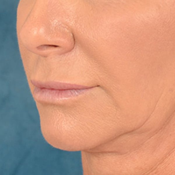 Lip Lift Before & After Gallery - Patient 311222 - Image 7