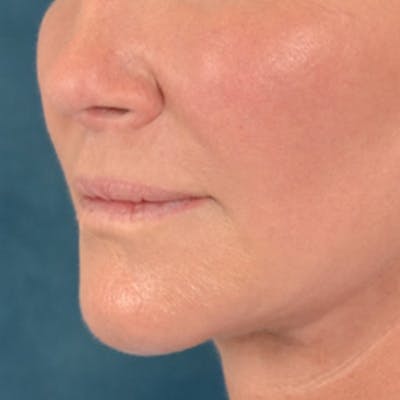 Lip Lift Before & After Gallery - Patient 311222 - Image 8