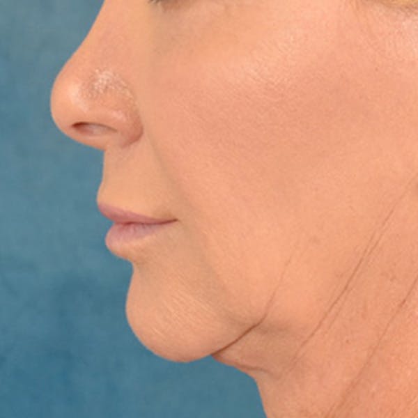 Lip Lift Before & After Gallery - Patient 311222 - Image 9