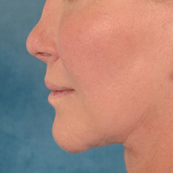 Lip Lift Before & After Gallery - Patient 311222 - Image 10