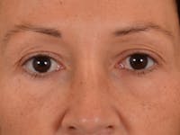 Eyelid Lift Before & After Gallery - Patient 307880 - Image 1