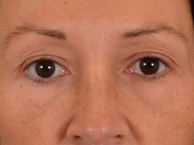 Eyelid Lift Before & After Gallery - Patient 307880 - Image 1