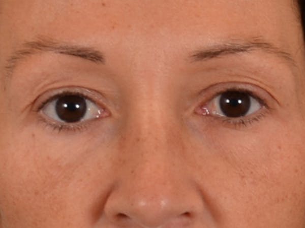 Eyelid Lift Before & After Gallery - Patient 307880 - Image 1