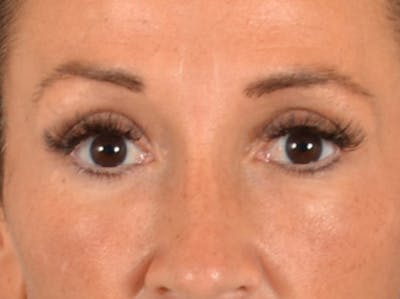 Eyelid Lift Before & After Gallery - Patient 307880 - Image 2