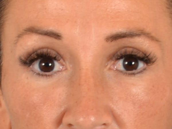 Eyelid Lift Before & After Gallery - Patient 307880 - Image 2